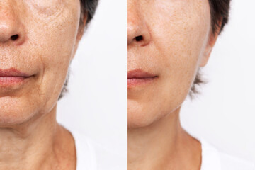 Lower part of elderly woman's face and neck with signs of skin aging before after facelift, plastic surgery. Age-related changes, flabby sagging skin, wrinkles, creases, puffiness. Rejuvenating effect - obrazy, fototapety, plakaty