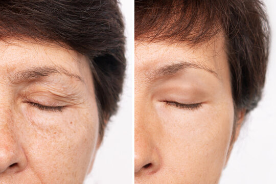 Elderly caucasian woman's face with puffiness under her eyes and wrinkles on eyelids before and after blepharoplasty. Age-related skin changes,fatigue. Result of plastic surgery. Rejuvenation