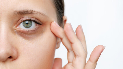 A young caucasian woman demonstrating dark circles under her eyes with hand isolated on a white background. Pale skin, bruises under the eyes are caused by fatigue, lack of sleep, insomnia and stress - Powered by Adobe