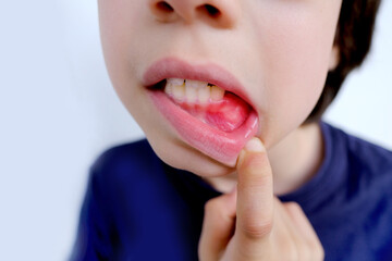 closeup part of boy of 10 years old opened his mouth, oral cavity, close-up teeth reddened gums, concept pediatric dentistry, dental treatment, correction of occlusion, oral care, caries prevention