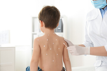Doctor applying cream onto skin of little boy with chickenpox in clinic. Varicella zoster virus