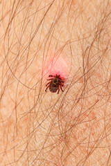 Crawling deer tick on the background of human hairy skin. Infection with dangerous insects with disease. the concept of infection from insects
