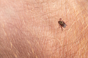 Crawling deer tick on the background of human hairy skin. Infection through the bite of a dangerous insect with a disease. the concept of infection from insects