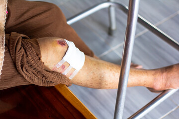 The wound was caused by a fall. An old woman has a wound on knee. - obrazy, fototapety, plakaty