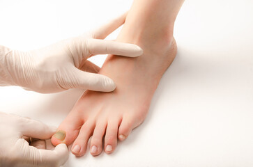 Doctor with white gloves, takes in his hands subungual hematoma in the nail of the right foot. Nail for onycectomy. Nail in purple and black tones. Isolated background white. Close up.