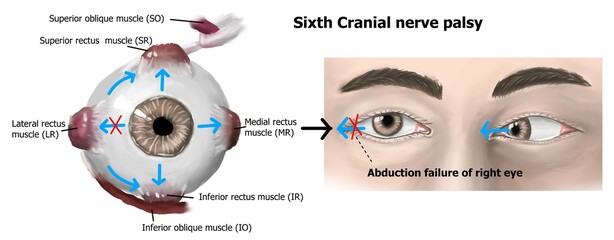 the clinical presentation of right sixth cranial nerve palsy.