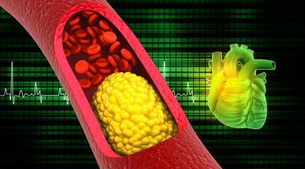 Cholesterol blocked arteries with human heart. 3d illustration.