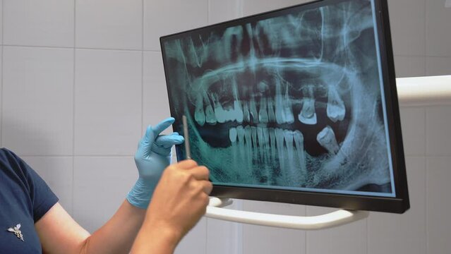 Closeup dentists have a discussion dental x-ray image prints at computer monitor at modern dentistry clinic. Tooth medical condition. 4 k healthcare, stomatological and technology concept