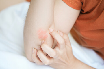 The woman's arms were itchy and red due to insect bites.