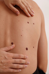Doctor dermatologist examines patient birthmarks close up. Mole check up. Prevention concept