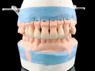 Dental porcelain prosthesis implant tooth in dental laboratory. Plaster model with all-ceramic bridge restoration. Lithium disilicate. Front view. Selective focus. Lower and upper jaw in metal © Alice