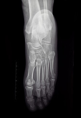 An x-ray of the human foot and ankle