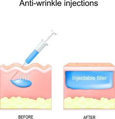 Anti-wrinkle injections. aesthetic procedure.