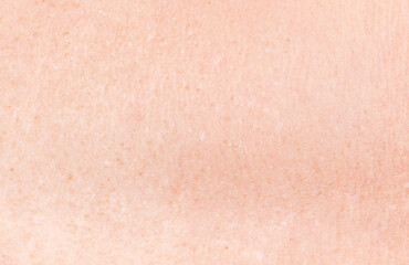 Freckles on the skin of the back