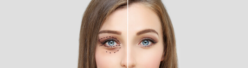 Lower eyelid blepharoplasty.Upper  blepharoplasty.Before and after cosmetic procedures