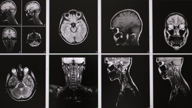 Tomography. MRI scans of the brain. Medical diagnostic examination for the presence of pathology. High quality 4k footage