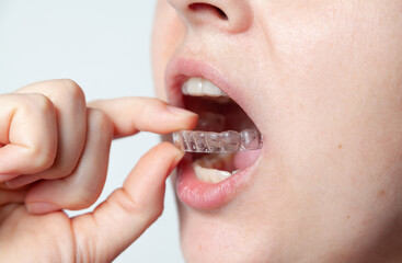 Capa after removal of braces to fix result of treatment....