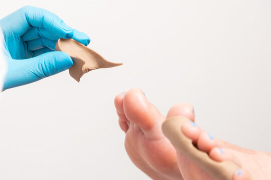 Procedure in podiatry clinic. Podiatrist in blue gloves inserts a silicone impression between client's toe fingers. Close-up. Copy space. The concept of podology and chiropody