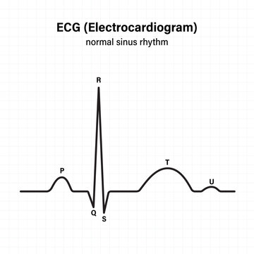 Diagram showing normal heart beat wave. Electrocardiogram of normal sinus rhythm. Vector for medical science and education use.
