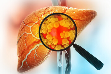 Magnifying glass showing the diseased liver. Virus infected liver. 3d illustration - obrazy, fototapety, plakaty