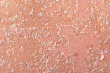 Sunburn, close-up of human skin. Flaky skin from allergies, peeling or eczema. Dry skin in need of...