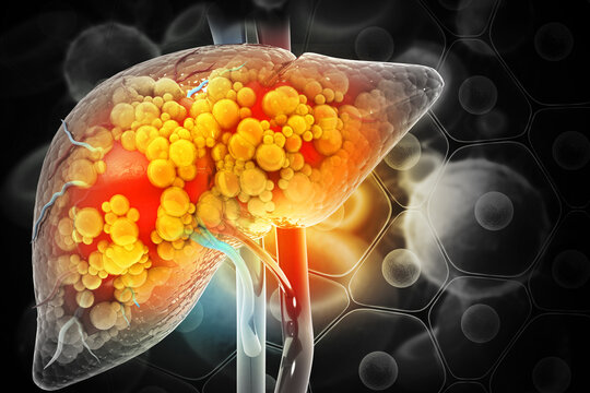 https://t4.ftcdn.net/jpg/05/25/56/43/360_F_525564337_9sBIHAyzVZxN53Om1T8paeQevGZPGSX7.jpg Fatty Liver Images – Browse 17,871 Stock Photos, Vectors, and Video | Adobe Stock