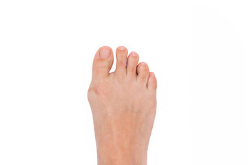 A woman's foot with hallux valgus deformity of the big toe caused by wearing uncomfortable shoes isolated on a white background. Orthodontics - obrazy, fototapety, plakaty