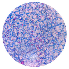 Microscopic 100x image of AFB stainig. Microbacterium Tuberculosis Bacteria (MTB). Sputum or phlegm smear.