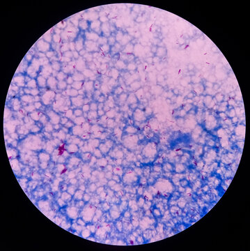 Microscopic 100x image of AFB stainig. Microbacterium Tuberculosis Bacteria (MTB). Sputum or phlegm smear.