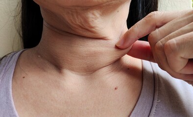 Fototapeta premium Portrait the flabbiness adipose hanging skin under the neck, wrinkles and flabby skin, problem cellulite and dark spots on the body of the woman, concept health care.