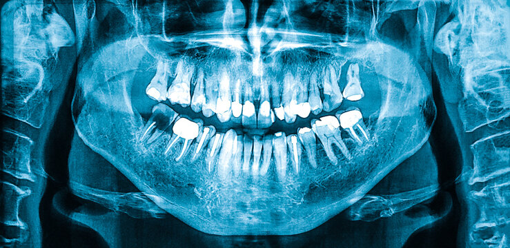Women's panoramic dental radiograph, Orthopantomogram single panoramic image of the oral cavity with teeth showing different dental work.
