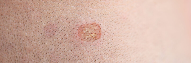 Spot on skin has traces of nevi and birthmar closeup