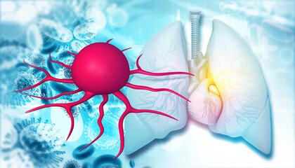 Human respiratory system with cancer cells. 3d illustration..