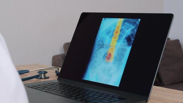 Woman Doctor showing x-ray with pain on the spine on a laptop. Shot forward