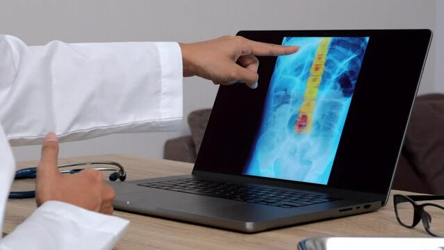 Hand of a woman doctor showing a x-ray of a spine on a laptop. Right to left close up shot