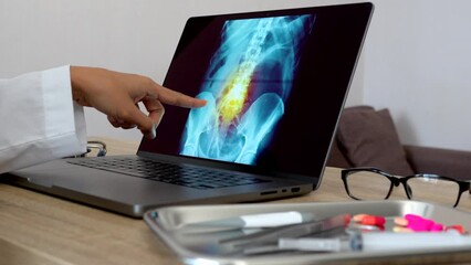 Hand of a woman doctor showing a x-ray of pain in the spine on a laptop. Right to left Close up shot