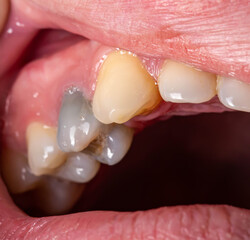 A yellow and black tooth in the mouth of a man. Oral care, teeth whitening from plaque and tartar....