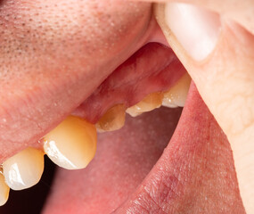 Grind teeth under a metal-ceramic crown in a man's mouth. Dental prosthetics in dental orthopedics, macro