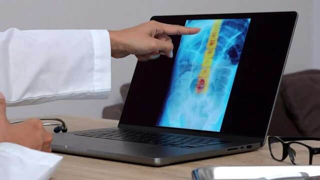 Hand of a woman doctor showing a x-ray of a spine on a laptop. Close up shot