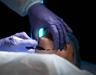 Plastic surgery to correct and remove a double chin in a female patient. Mentoplasty, close-up