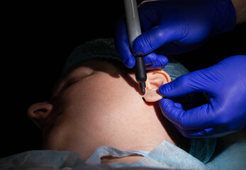 Plastic surgery to change the asymmetry of the ears and earlobe defects. Aesthetic otoplasty,...