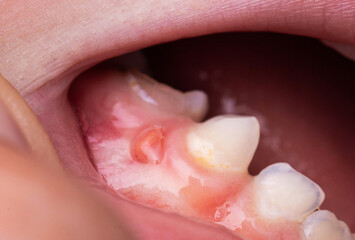 A bump is a tumor on the tooth gum in a child. Periodontitis in children due to a tooth with pulpitis. Close-up