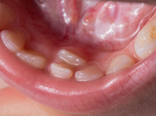 A permanent molar in a child grows second row. Incorrect growth of molars or polyodontia in...