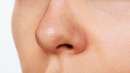 Close-up of a woman's nose with blackheads isolated on a white background. Acne problem, comedones....