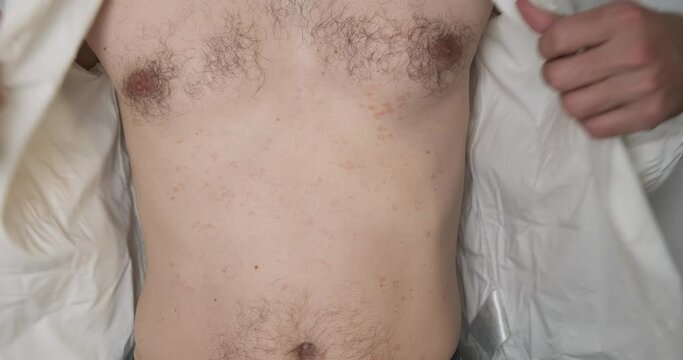 Dermatologist patient in a white shirt, opens it, showing the doctor a skin disease, ringworm, small red dots on the skin. Front view, close-up.