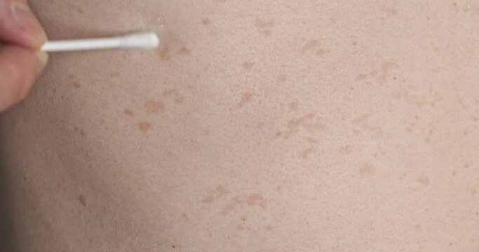 Caucasian man smears red spots on his skin with a cotton swab. Pityriasis versicolor, rubbing ointment, self-medication, skin disease, front view, close-up
