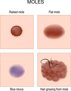 Nevus Or Mole Types. Check Nevus