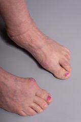 close-up of big toe disease curvature in elderly woman on gray background