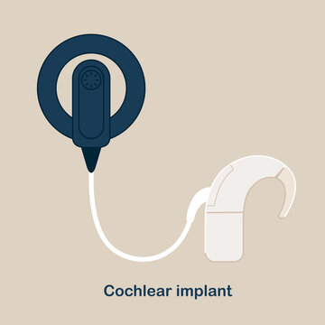 Cochlear Implant Vector illustration. Hearing therapy concept. World Deaf Day in last Sunday of September.