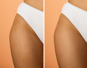 Stretch marks on female legs. A woman's hand holds a fat cellulite and a stretch mark on her leg. Cellulite close-up.
